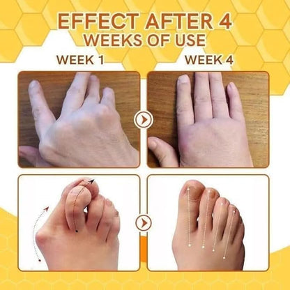 Bees Venom Spray Natural Relief For Varicose Veins & Spider Veins (Pack Of 3)